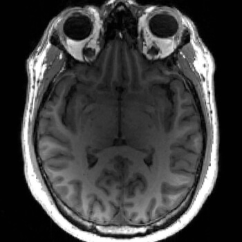 Image for AI could detect dementia years before symptoms appear