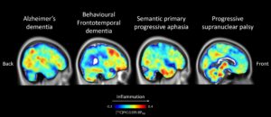 Image for Research Assistant – Clinical Neurosciences (Malpetti Lab)