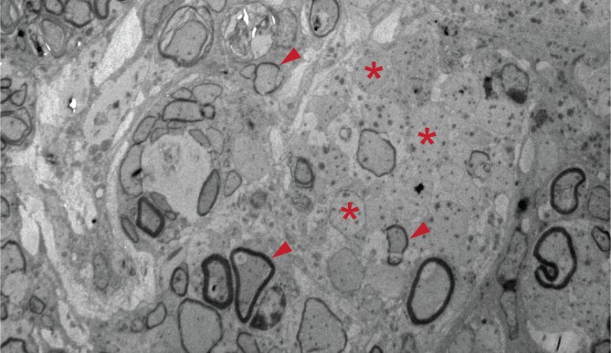 Image for Cambridge study shows stem cell grafts can restore myelin in MS lesions in mice